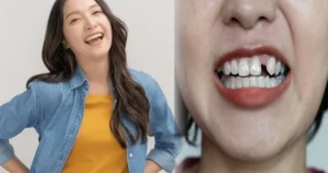 Trồng Răng Implant: Đầu Tư Một Lần, Hiệu Quả Trọn Đời, Nâng Cao Chất Lượng Cuộc Sống