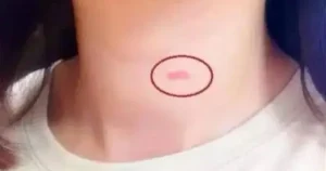 "Mẹ lặng lẽ hành động khi thấy con gái 14 tuổi có 'dấu vết lạ' trên cổ"